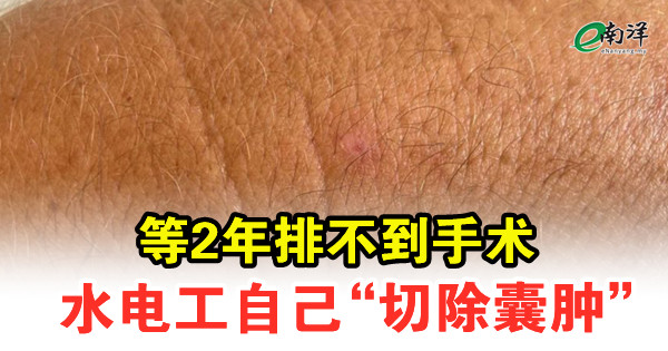 等2年排不到手术 水电工自己“切除囊肿”